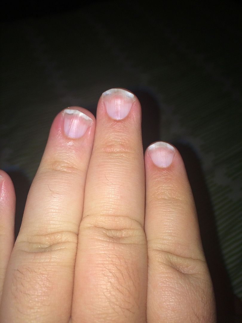 Half and half Nails Liver & Pancreas Disorders Message Board