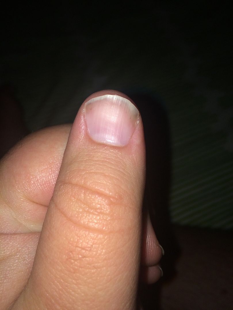 Half and half Nails Liver & Pancreas Disorders Message Board