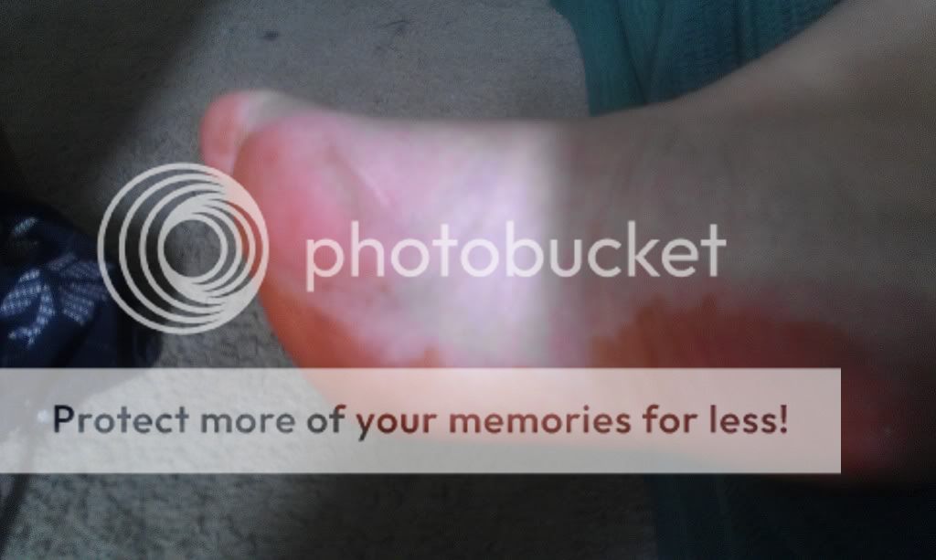 Soles of feet turning orange? Weird pregnancy symptom, or something